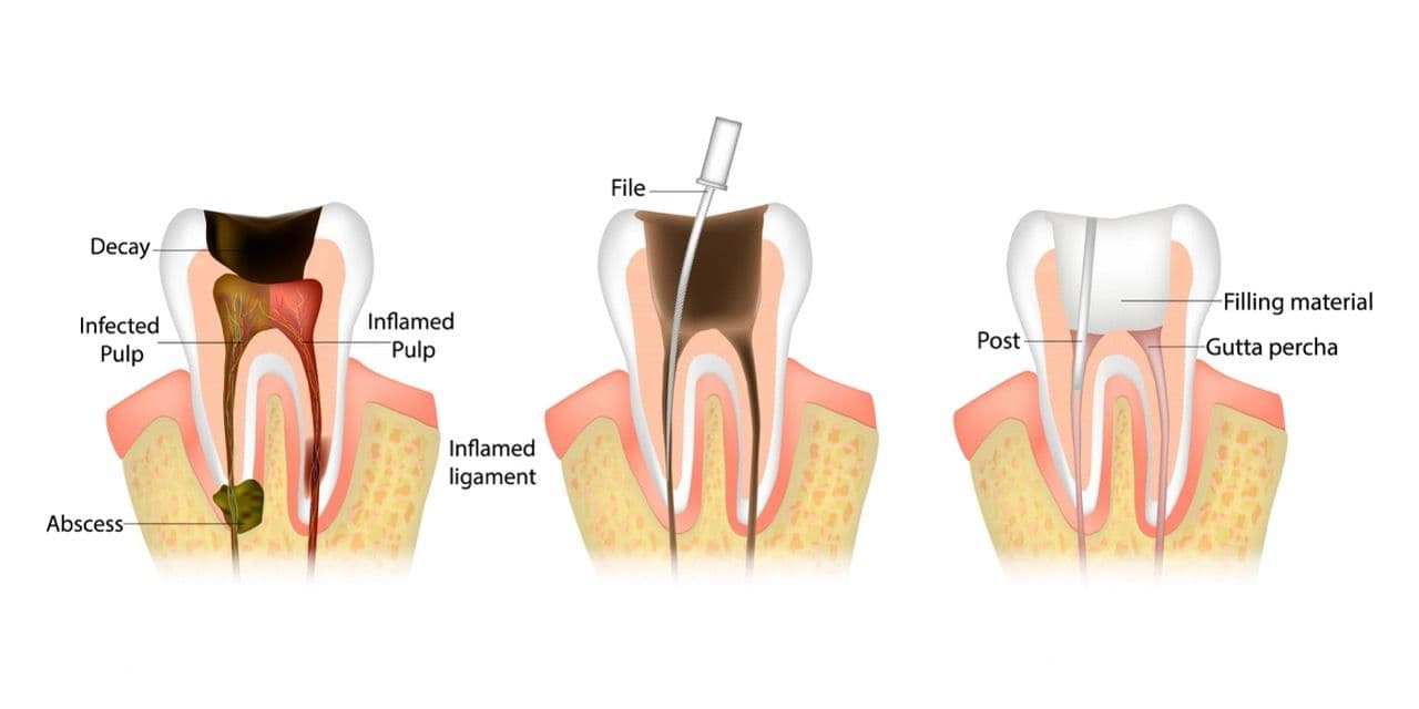 Illustration of a tooth cavity being filled