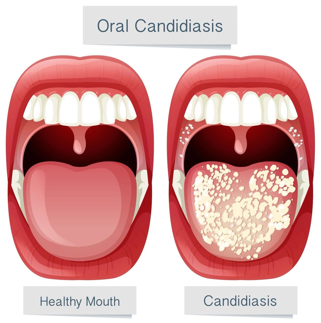 Illustration comparing a healthy mouth to a mouth with oral thrush