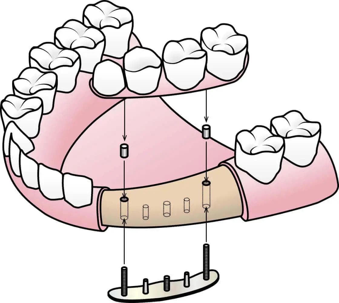 Illustration of transosteal dental implants
