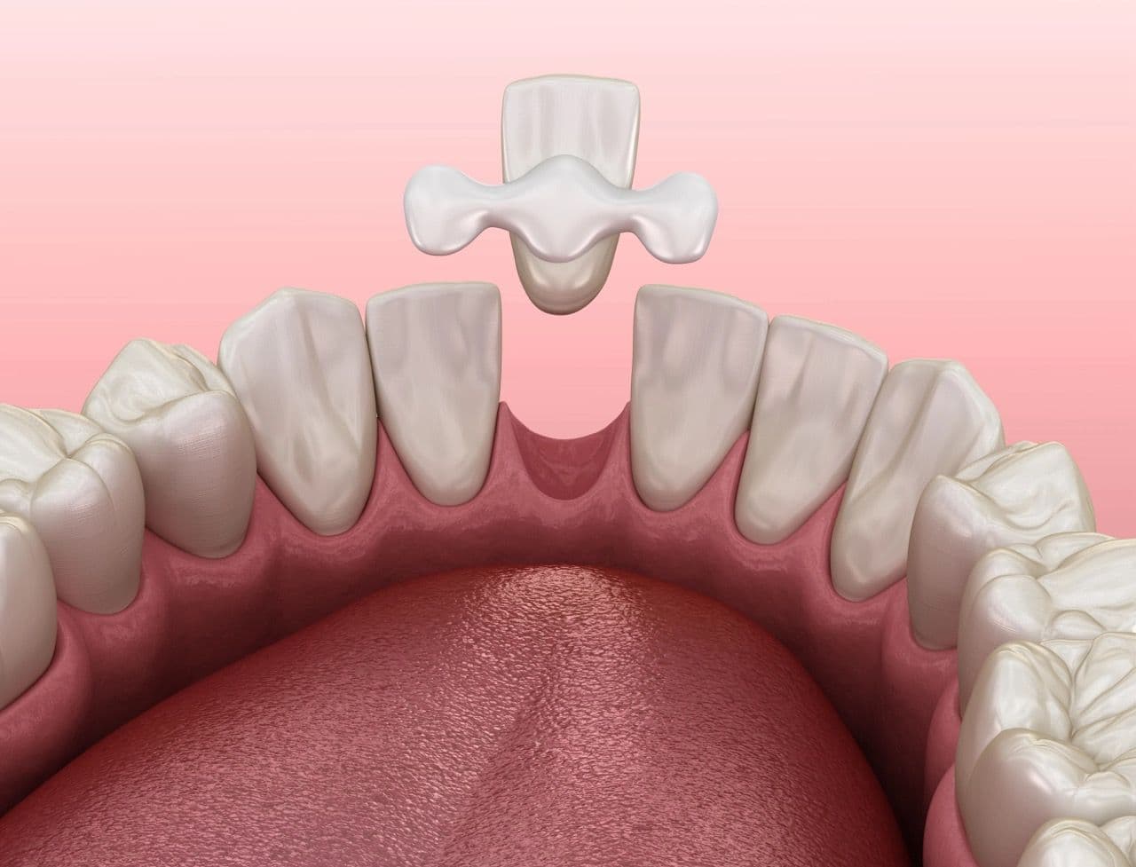 3D render of a Maryland Dental Bridge