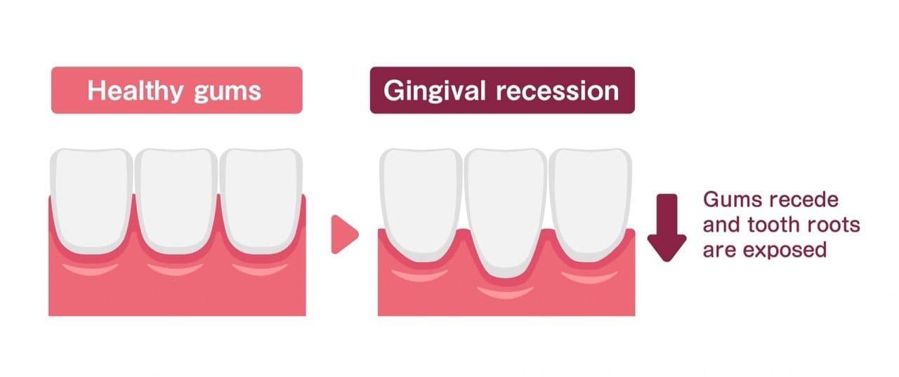 Infographic illustration showing gingival recession.