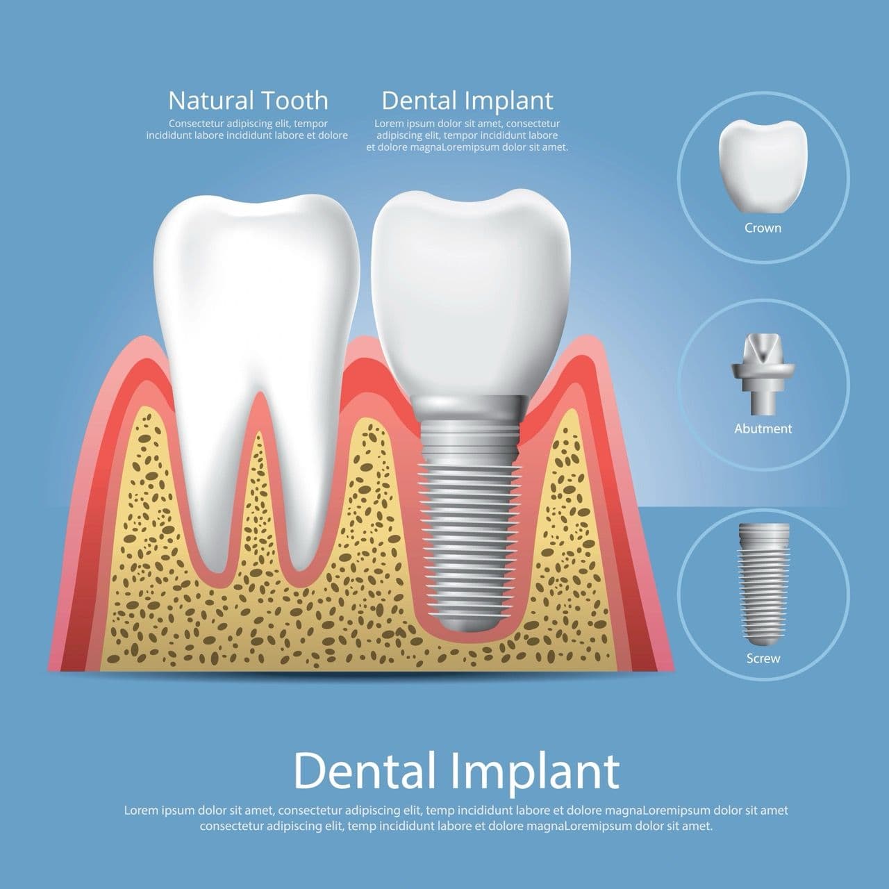 Infographic showing the parts of a dental implant.