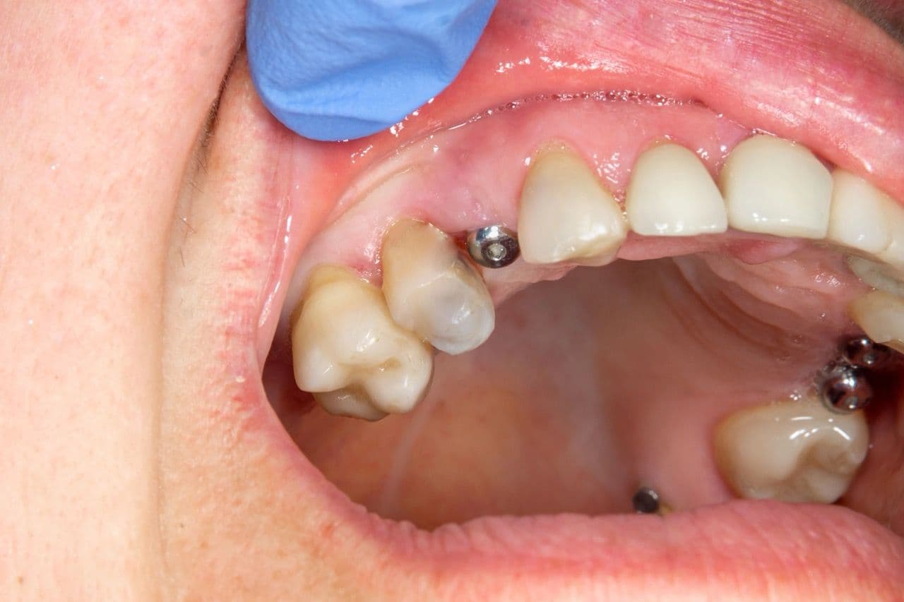 Close-up photo of a dental implant in an open mouth