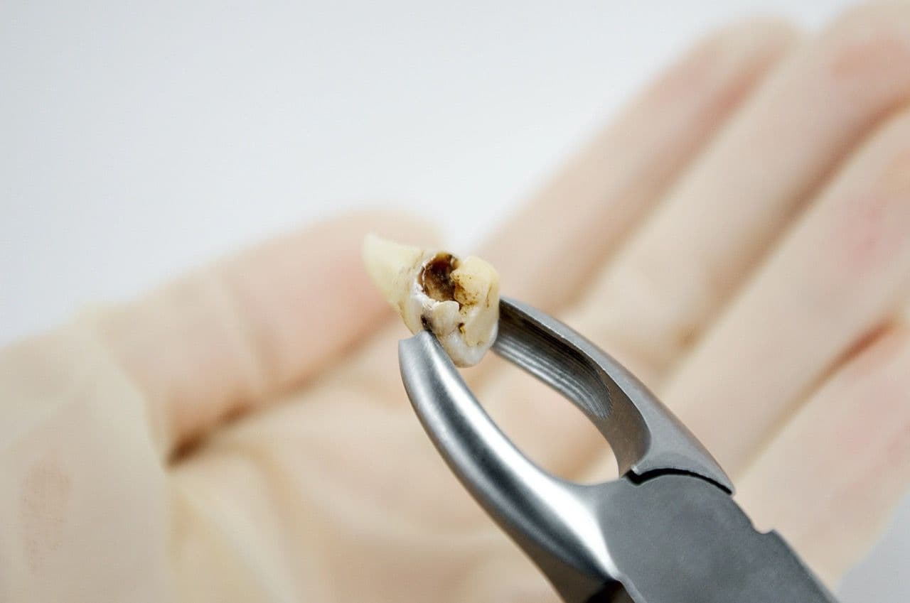 A decayed tooth in pliers after removal