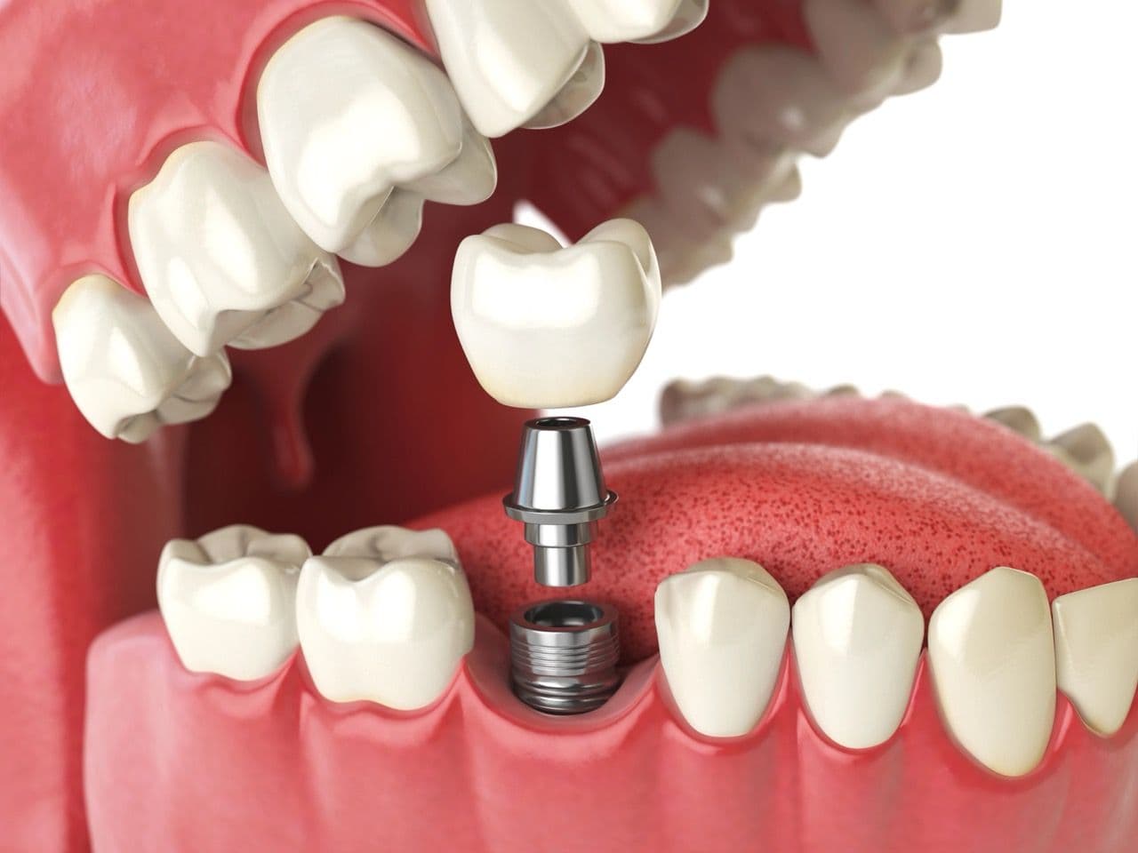 3D render of a dental implant going into a mouth