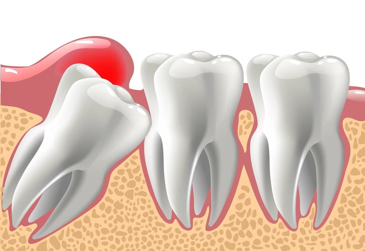 Image of a misaligned tooth next to two straight teeth.