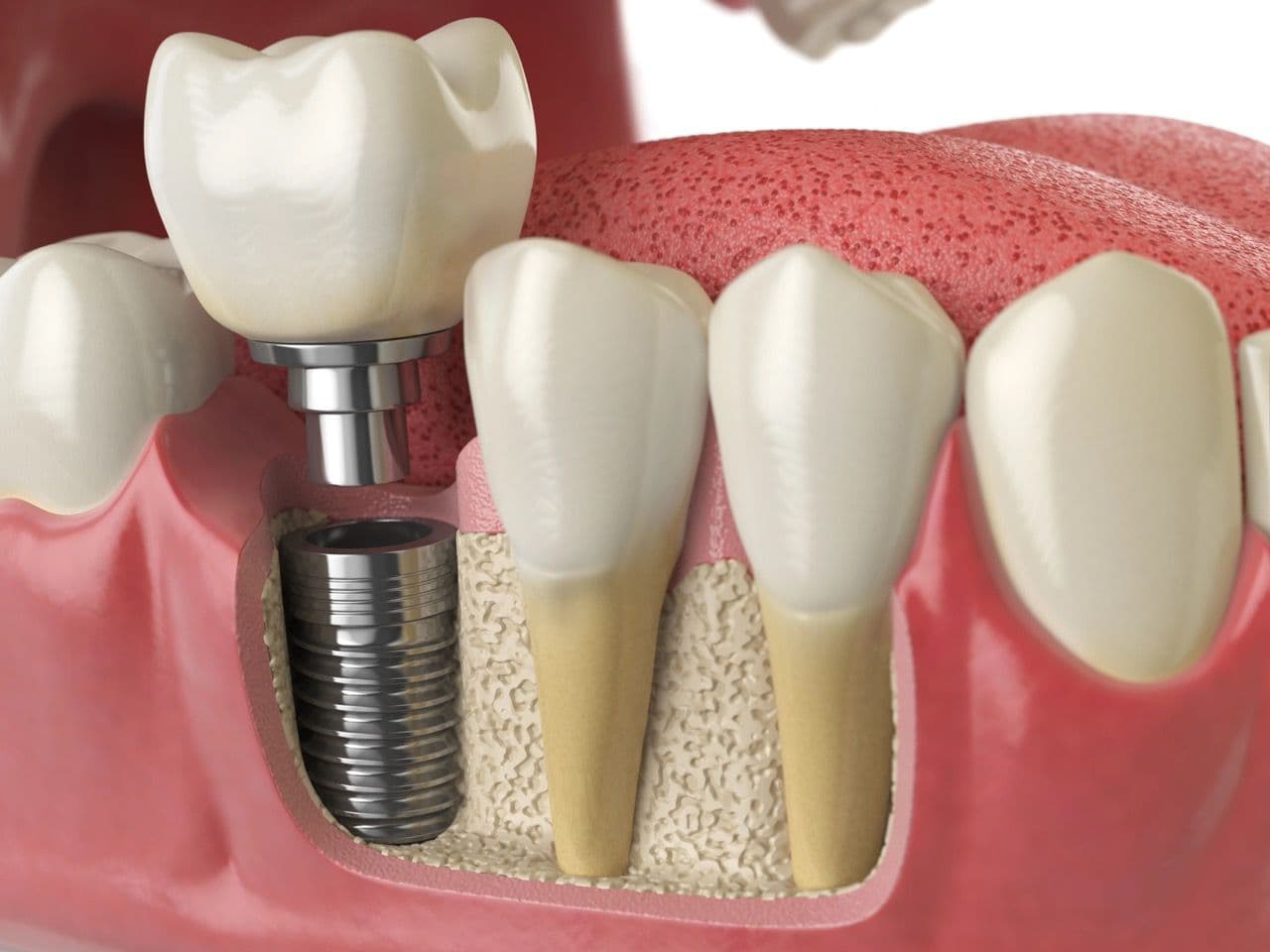 3D render of an implant between natural teeth