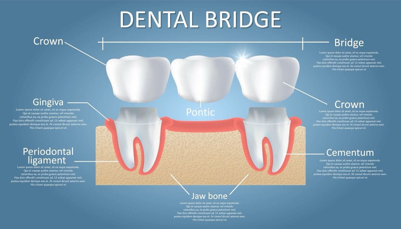 Infographic showing the parts of a dental bridge.