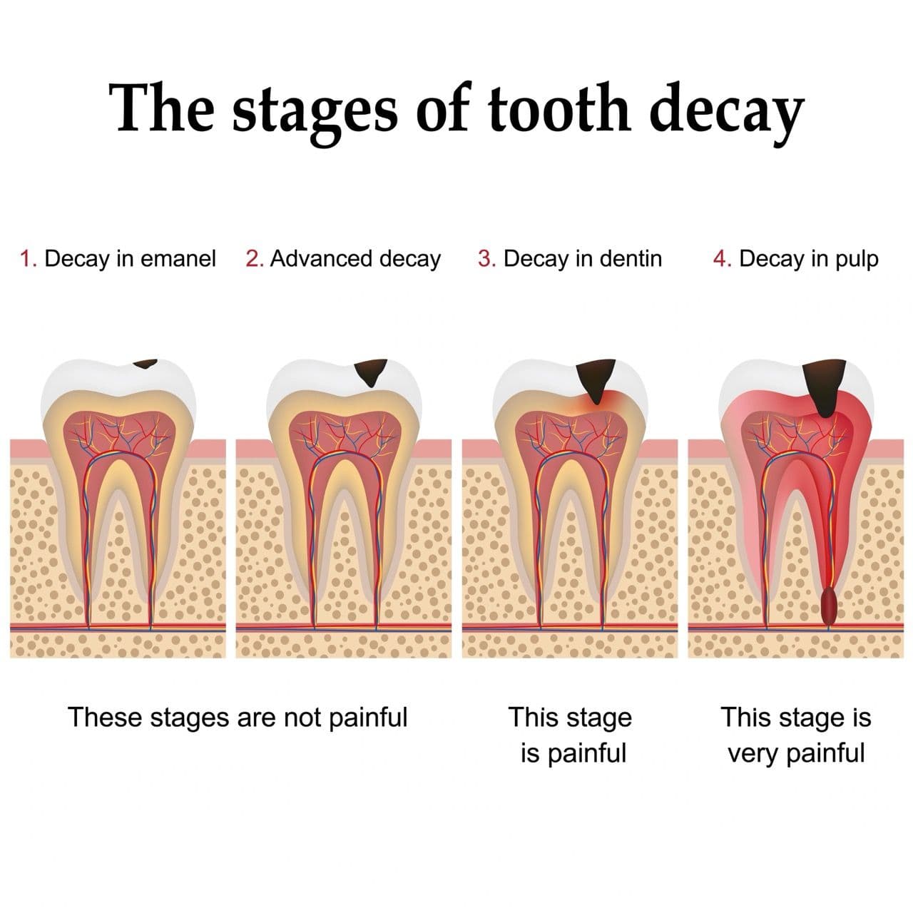 Illustration showing four stages of tooth decay