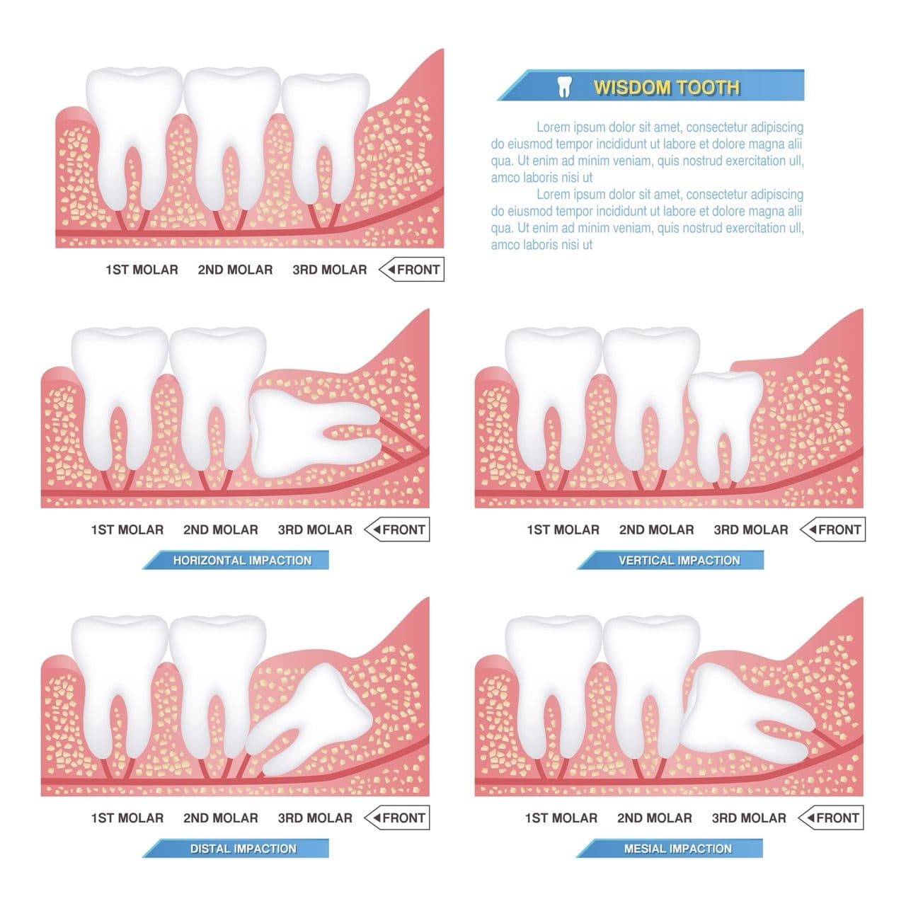 Chart illustrating various potential wisdom teeth problems.