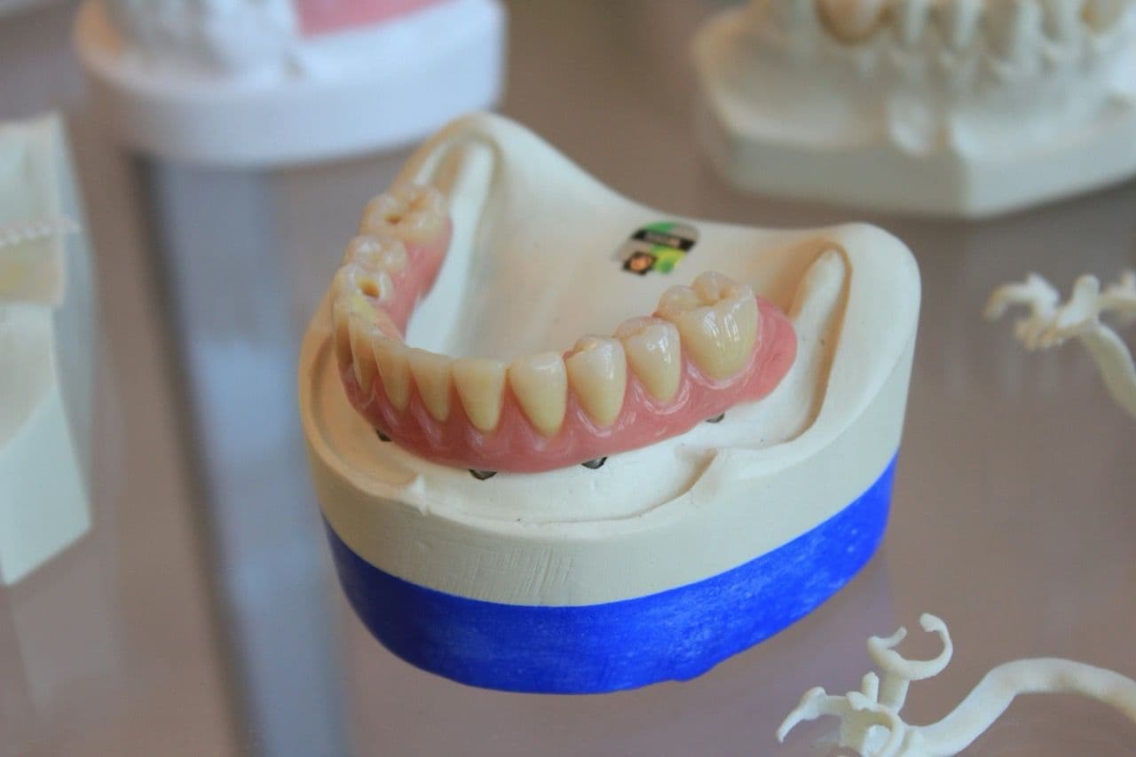 Photo of an implant overdenture