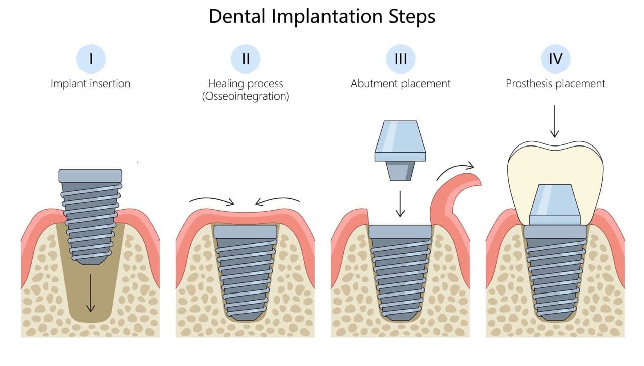 Illustration of the steps to installing a dental implant