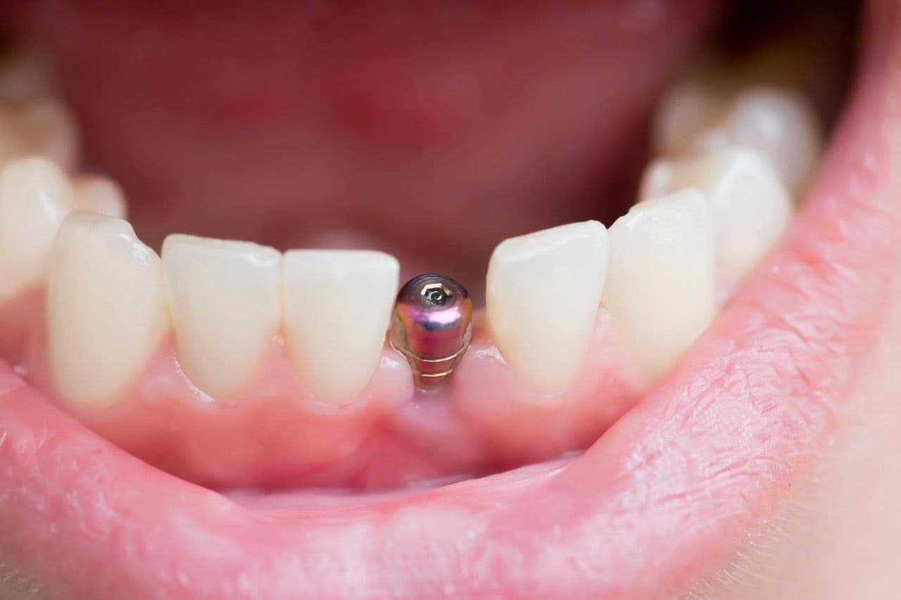 Close-up photo of a dental implant in an open mouth
