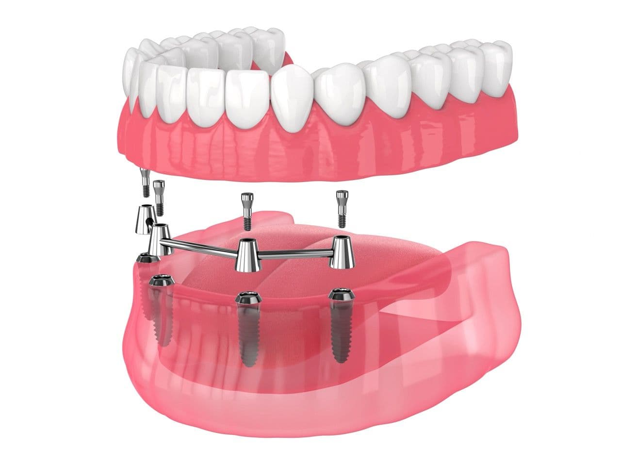 3D render of a lower arch denture being supported by dental implants