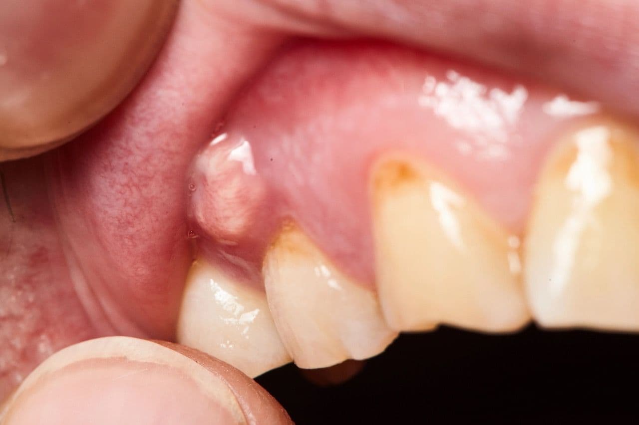 Photo of a mouth with the gum exposed to reveal an abscess.